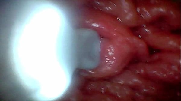 First time: An endoscope reveals the G-spot up ...